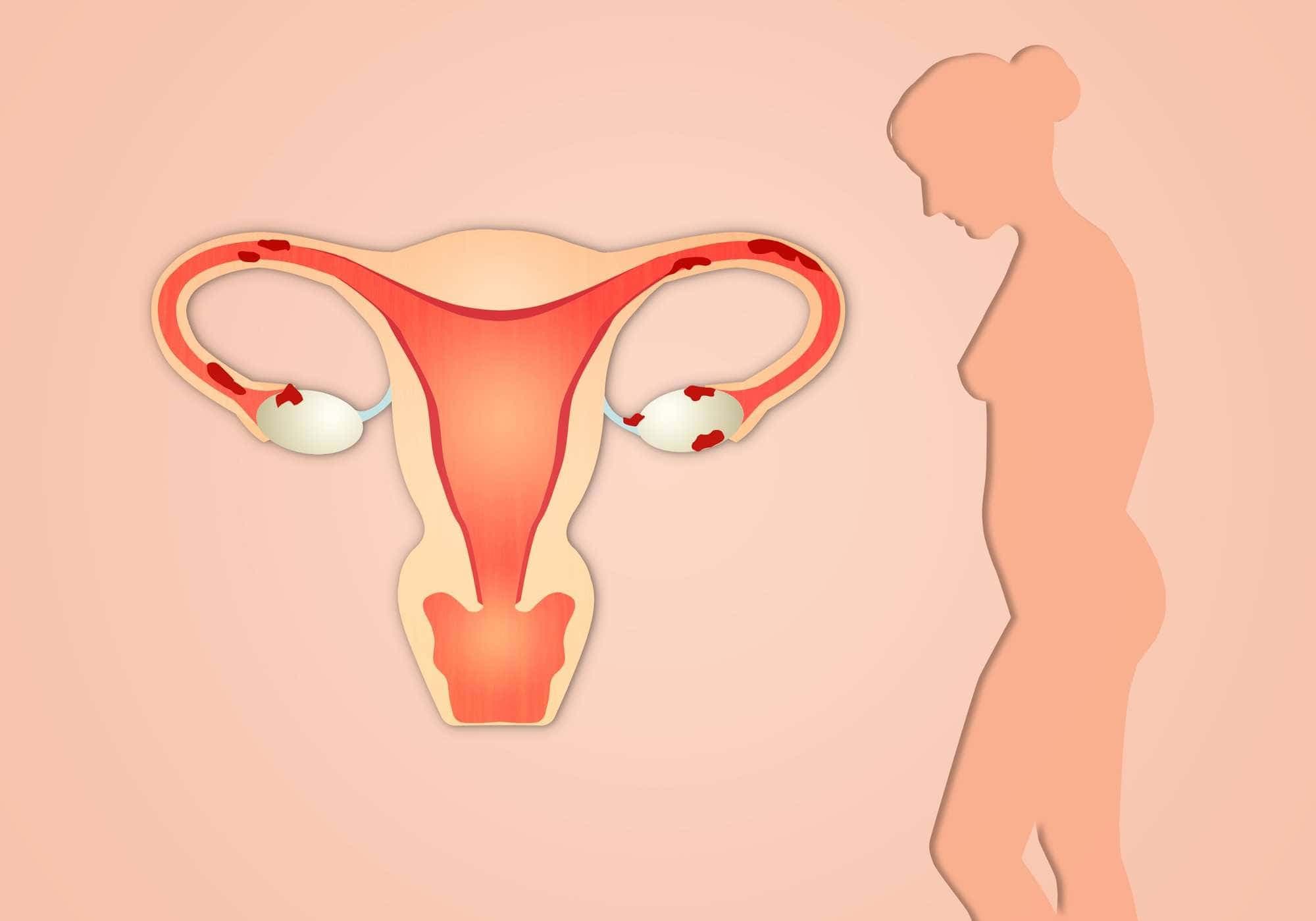 Endométriose : Tout ce que vous devez savoir
